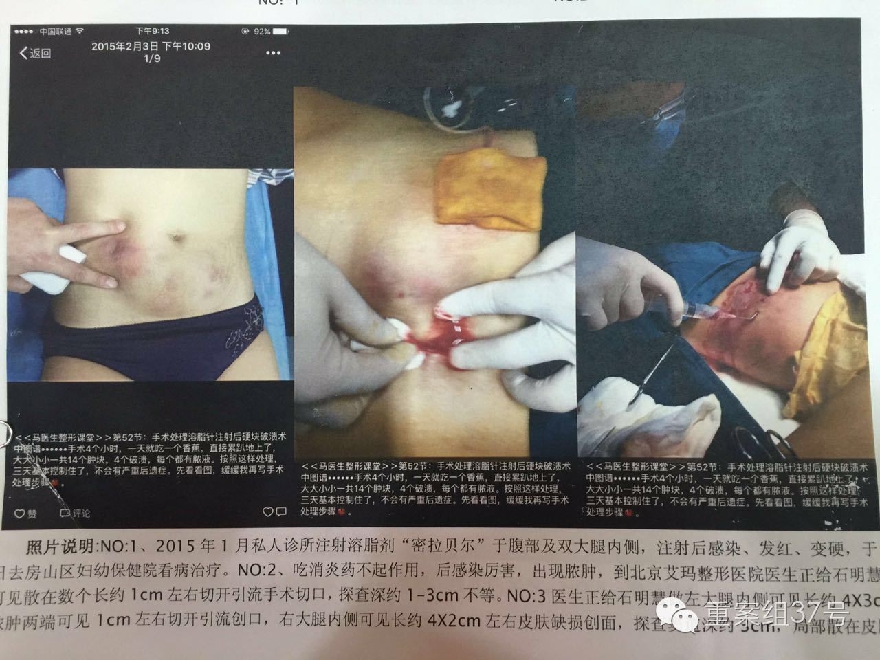 女大学生做“微商”卖假溶脂针被判一年半，直到受审她还一脸懵圈