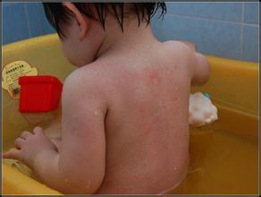 9个月宝宝出疹子注意些什么,宝宝感冒出疹子需要注意什么