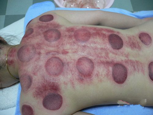 怎么通过拔罐的颜色判断身体状况,肩膀拔罐后颜色黑紫是怎么回事