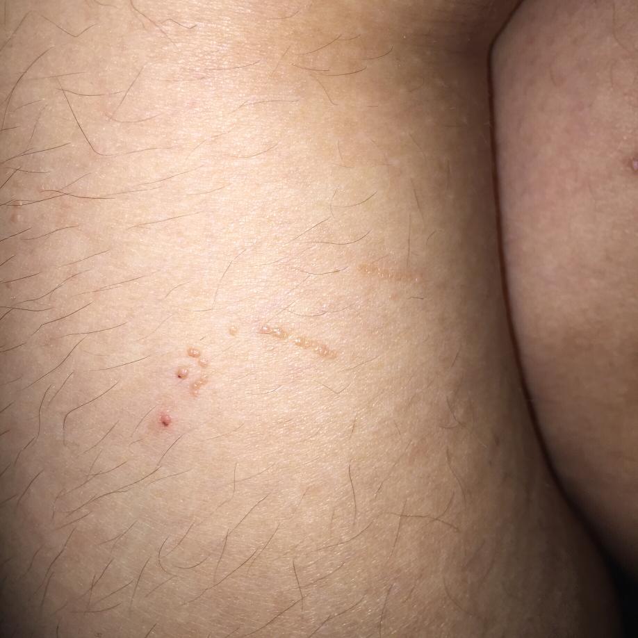 水瘊子去掉母瘊子还会长吗,肉瘊子用手抠了会怎样