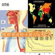 食道癌晚期可以活多久,晚期食道癌放疗能活多久
