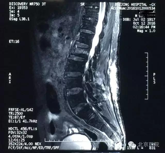 北京医院骨科创造国内脊柱手术患者年龄新纪录