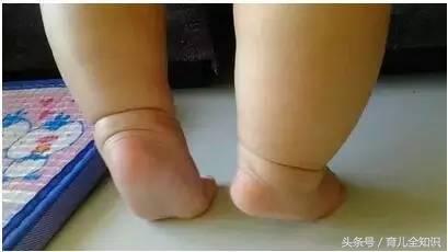 为什么宝宝喜欢踮着脚尖走路,小孩踮脚走路怎么排除脑瘫