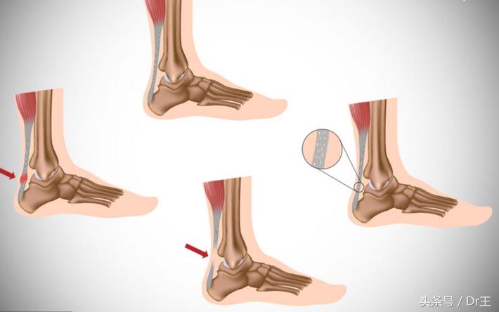 足部疼痛您都了解吗,足部反射区疼痛原因