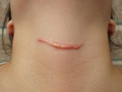 手术缝针疤痕怎么去除,嘴角缝针疤痕去除最佳时间