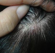 头上老出油还有毒疙瘩是怎么了,头上出油长疙瘩是怎么回事