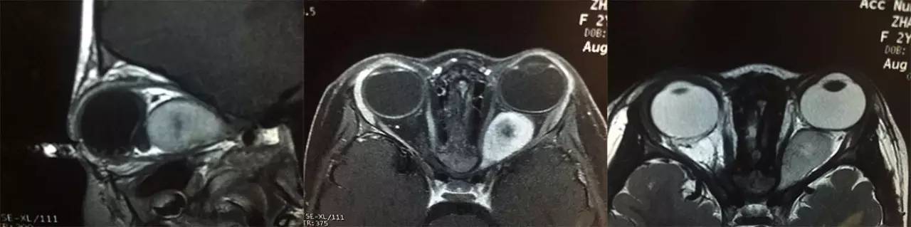 眼神经胶质瘤,视觉神经胶质瘤