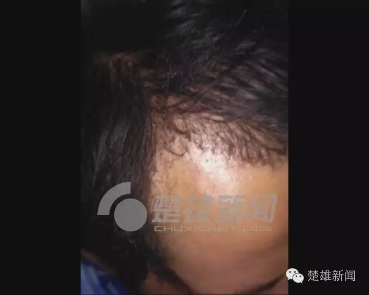 三星手机突然爆炸男子双眼被烧伤,三星发生爆炸事故