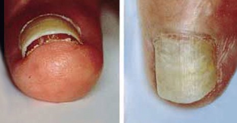 指甲的变化意味着身体的健康状况,当指甲发绿发脓的时候要怎么处理