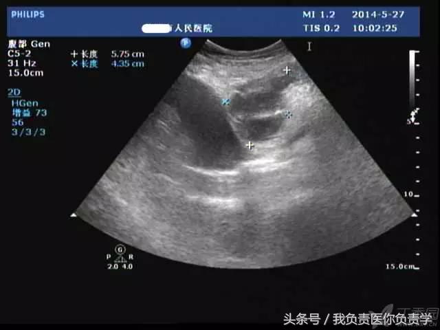 楂樻墜杩涢樁鑵拌吂璁粌,鑳嗗泭缁撶煶绌垮瓟鐥囩姸