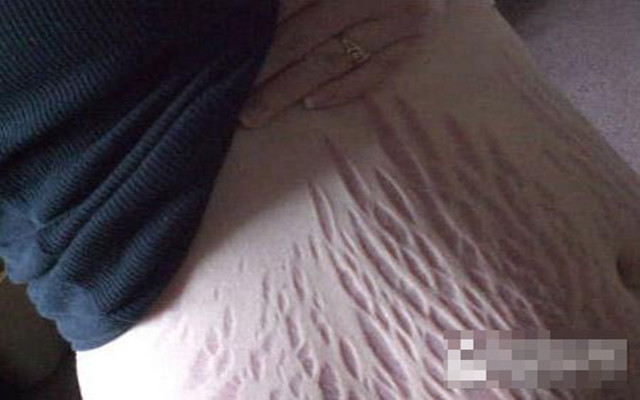 怀孕七个月长妊娠纹了还能补救吗,孕一个月就长妊娠纹了