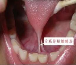 舌头下面那个“系带”，是干啥用的呢