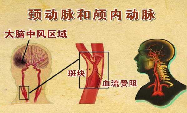 如何预防脑卒中视频,脑卒中为什么要做颈动脉彩超