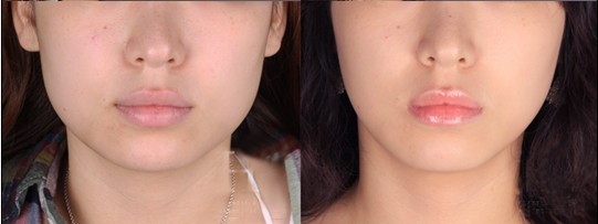 瘦脸针打完多久效果最明显自然,打瘦脸针笑容僵硬怎么能恢复快点