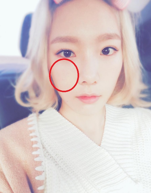 脸部不同部位痘痘代表什么,不同的痘痘要用不同的方法处理