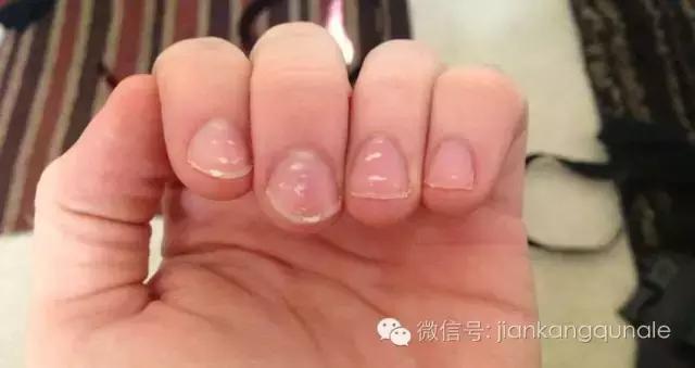 孩子指甲有白斑、凹陷，说明身体缺什么？