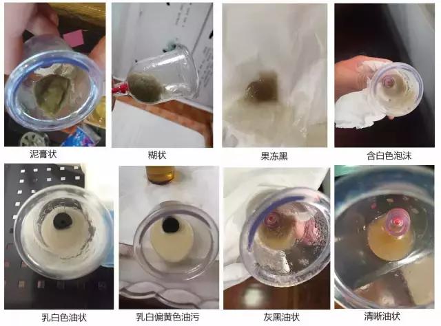 刮痧哪种罐比较好,魔灸罐与刮痧区别