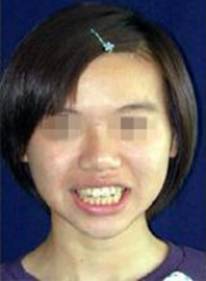 牙齿不齐可以戴隐形牙套吗,牙齿不齐一定要戴钢牙吗