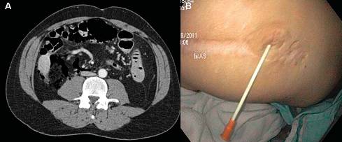 克罗恩病内镜严重程度指数,克罗恩病内镜检查是怎么样的