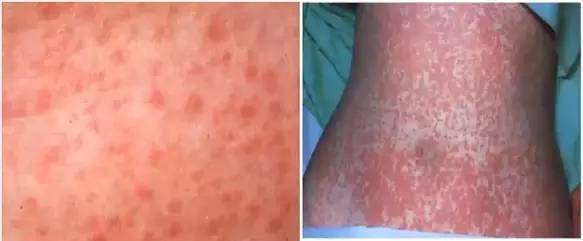 诊断麻疹最快速的方法,麻疹怎么做检测