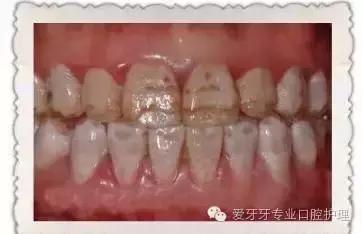 烤瓷牙和全瓷牙的区别和价格,贵的烤瓷牙和便宜的有区别吗