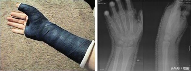 月骨舟骨半脱位手术,手腕舟骨月骨周围脱位要多久康复