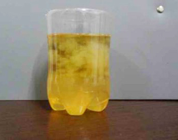 正确认识糖尿病肾病,正确认识慢性肾炎