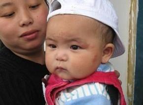 育儿常识2-3岁,婴幼儿湿疹护理四大常识