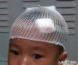 宝宝摔伤了怎么处理好得快,宝宝摔伤怎么处理不会留疤