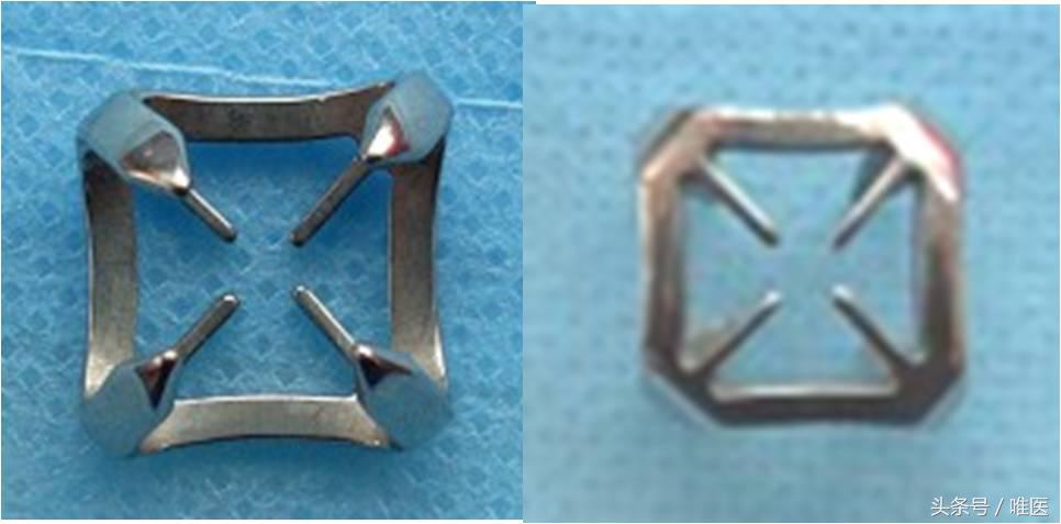 月骨舟骨半脱位手术,手腕舟骨月骨周围脱位要多久康复