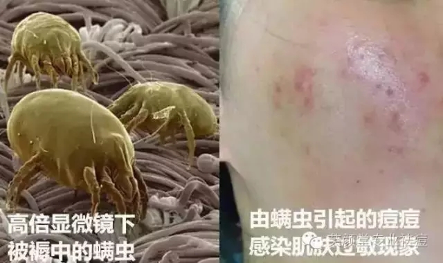 过敏长痘是什么原因,过敏长痘痘是什么症状