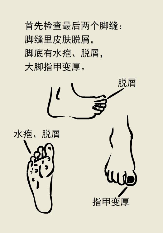 脚很臭不痒不脱皮是脚气吗,脚有脚气特别臭特别痒