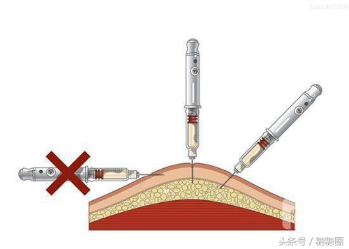 东宝胰岛素注射笔的使用方法,优泌乐胰岛素注射笔操作方法
