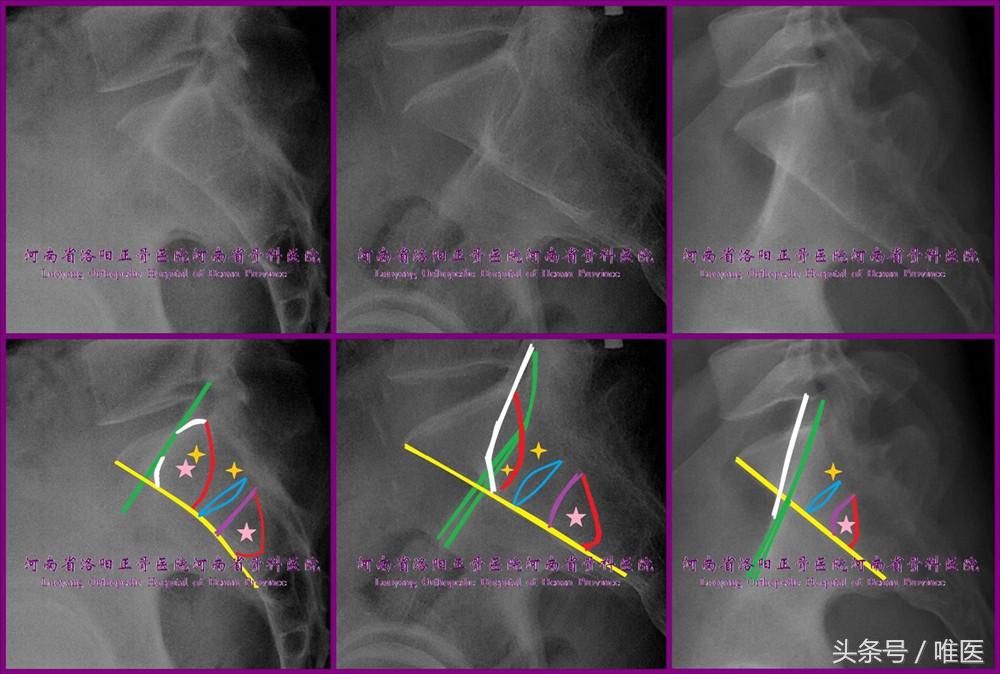 骶髂关节螺钉植入,骶髂关节螺钉手术技巧