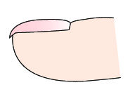 大拇指指甲出现纵纹凸出是什么病,指甲出现黑色的纵纹