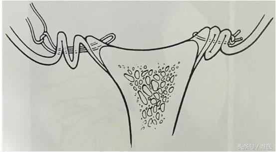 肩关节镜修复方法,肩关节镜下半骨道修复技术