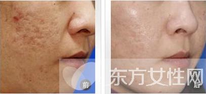 怎么祛痘疤最有效的方法,如何祛痘印痘疤效果最好