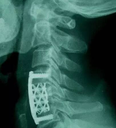 3d打印技术助骨科精准手术,3d打印技术在骨科的应用