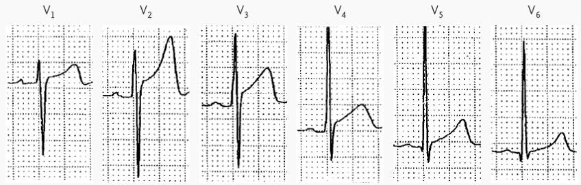 心电图st段抬高0.05mv是什么意思,心电图st段抬高但心脏彩超都正常