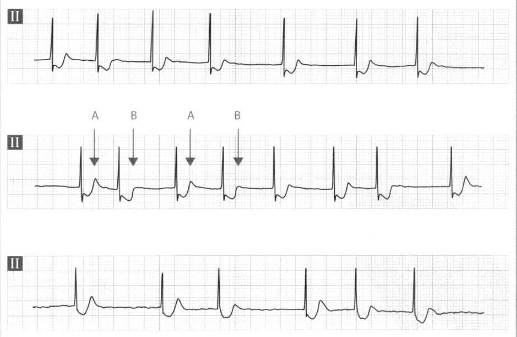 服用什么药物心电图就会正常,服药后做心电图