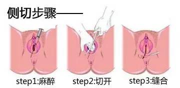 孕产名词解释｜会阴侧切，你需要了解的事