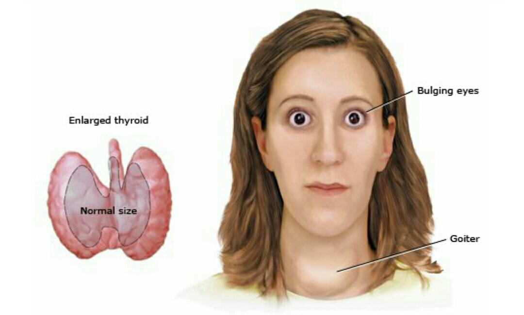 妊娠期得了甲亢怎么办,妊娠期甲亢产后能喂奶吗