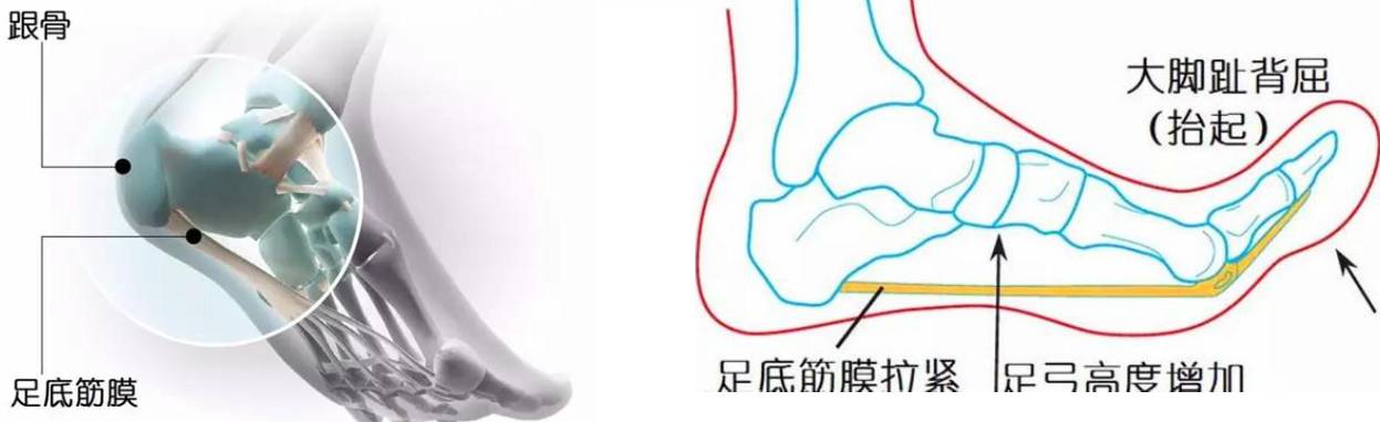 足底筋膜炎康复训练,脚筋膜炎运动康复训练