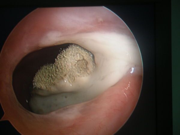 霉菌性上颌窦炎可以吃阿奇霉素,哪些生活习惯会引起霉菌性阴道炎
