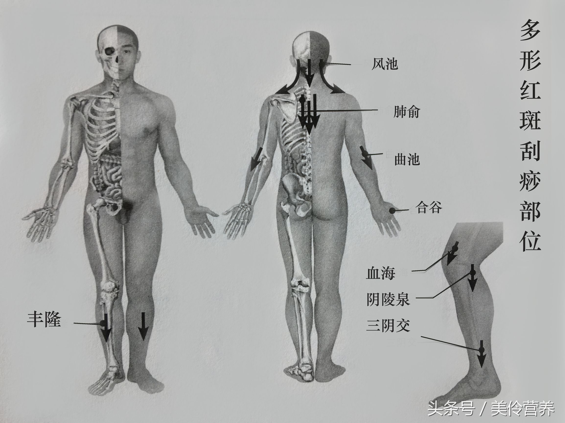 *褐斑黄**、多汗症、多形红斑的刮痧疗法