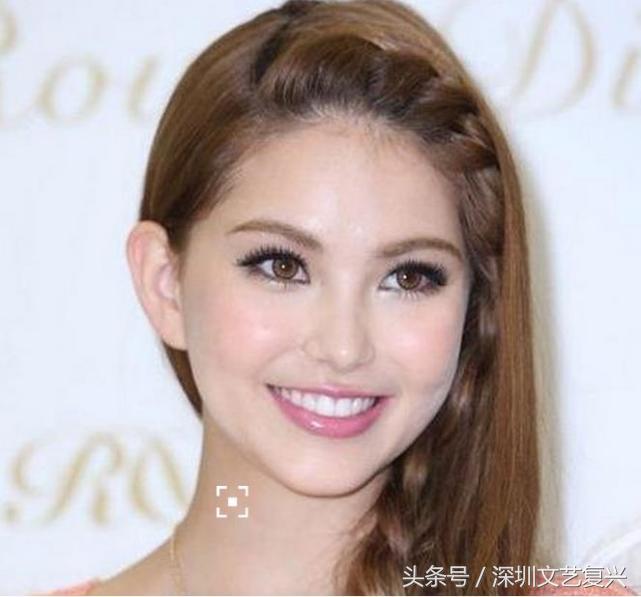 林允整牙效果怎么样,林允整牙后变化图片