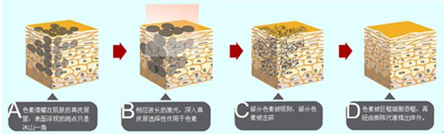 皮肤美容激光科主任韩昱华:为什么单纯激光祛斑效果不好?