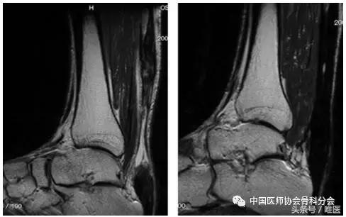 陈旧性跟腱断裂手术修复方法,跟腱断裂陈旧