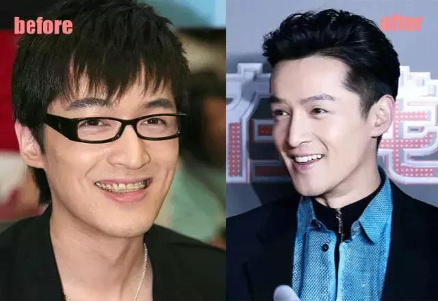 整牙=整容?看杨幂、刘涛、高圆圆为你亲身示范!