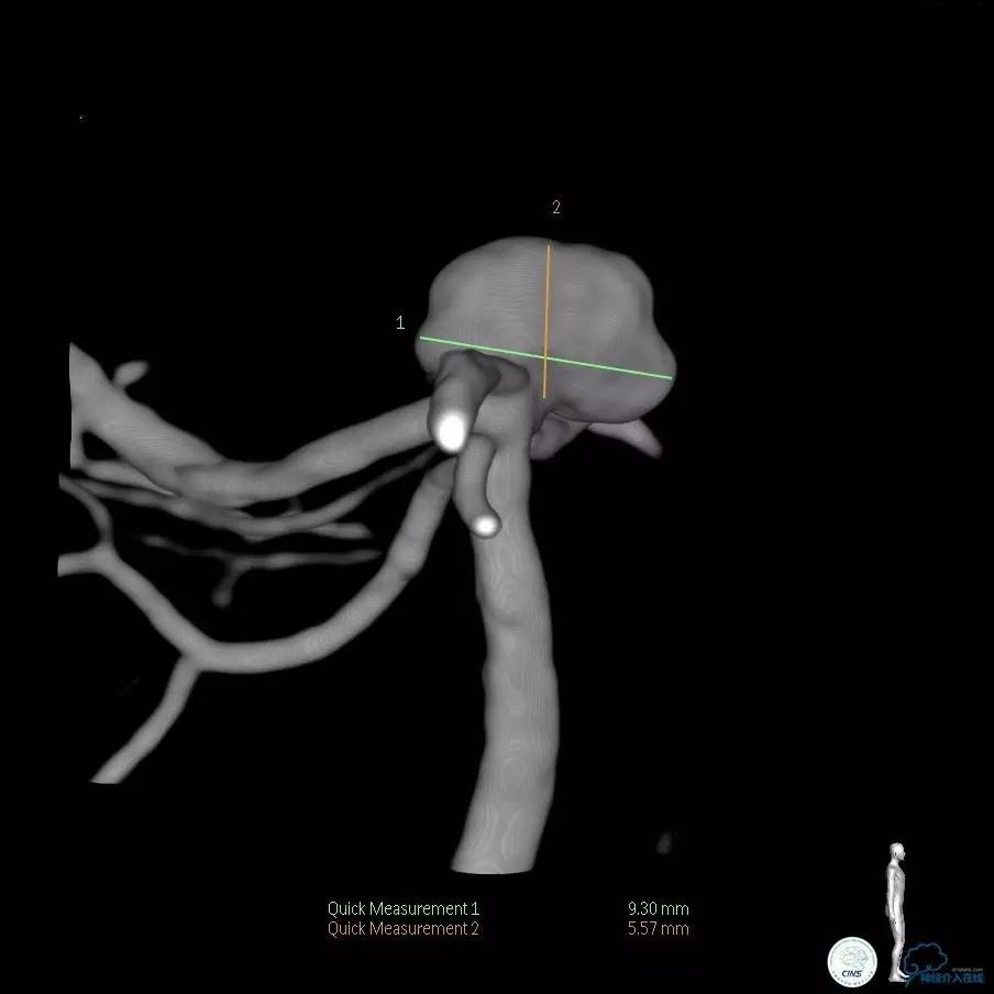 颈动脉瘤介入栓塞康复后可活多久,动脉瘤微创栓塞术全过程